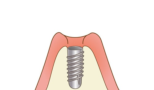 インプラントを埋め込む手術