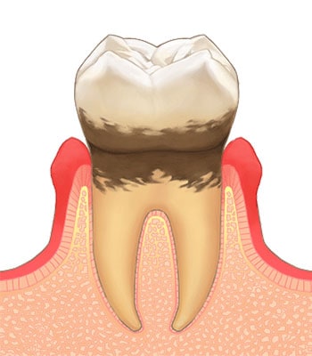 歯周炎（軽度）
