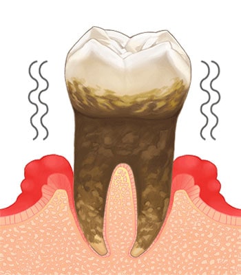 歯周炎（重度）